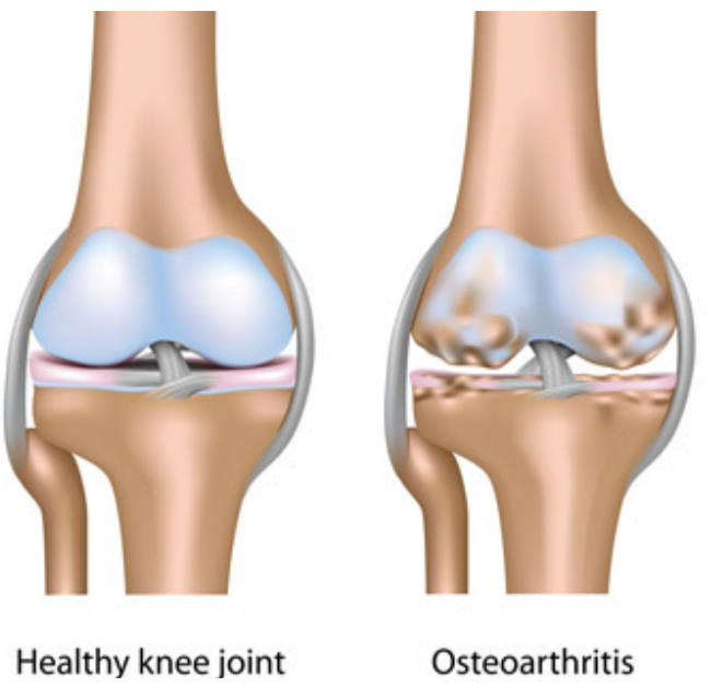 Knee arthritis